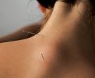 Image showing Acupuncture in the Neck